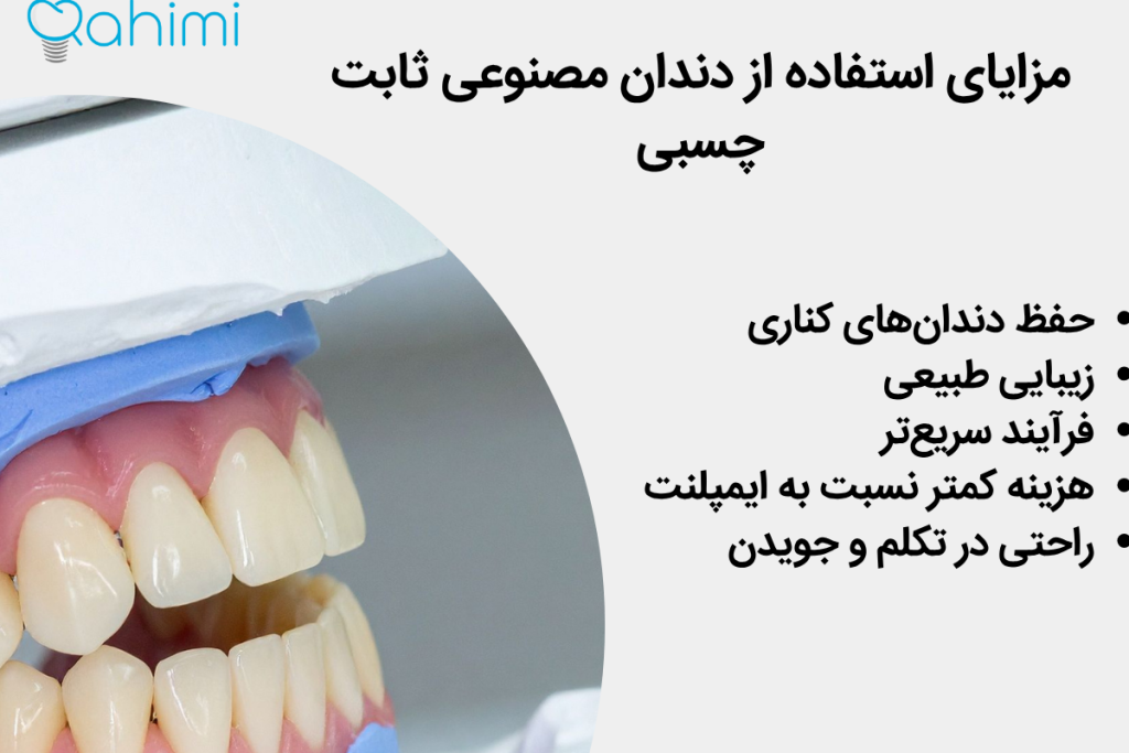 همه چیز درباره دندان مصنوعی ثابت چسبی و مزایای آن 1 مزایای استفاده از دندان مصنوعی ثابت چسبی