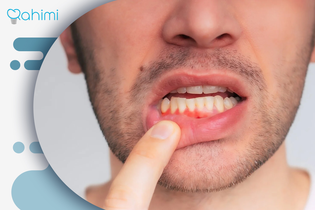 لیفت لثه چیست؟ فواید لیفت لثه با جراحی و لیزر 6 تحلیل لثه