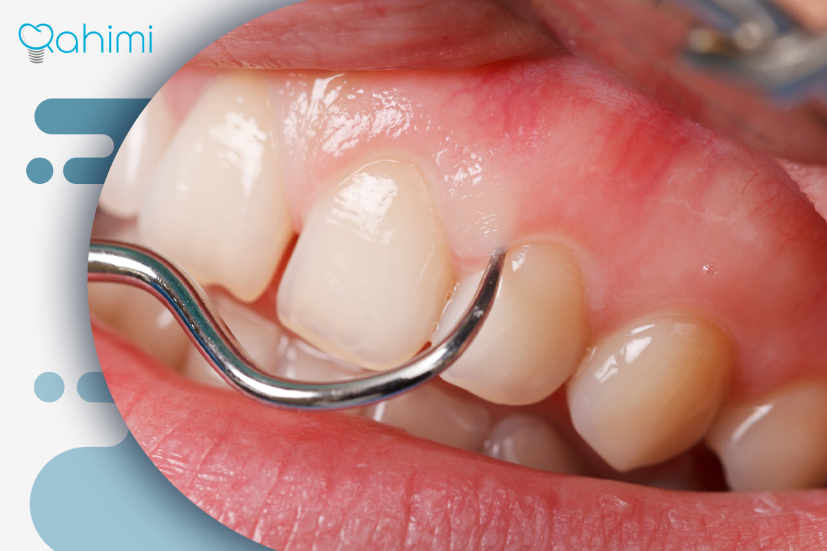 لیفت لثه چیست؟ فواید لیفت لثه با جراحی و لیزر 1 لیفت لثه
