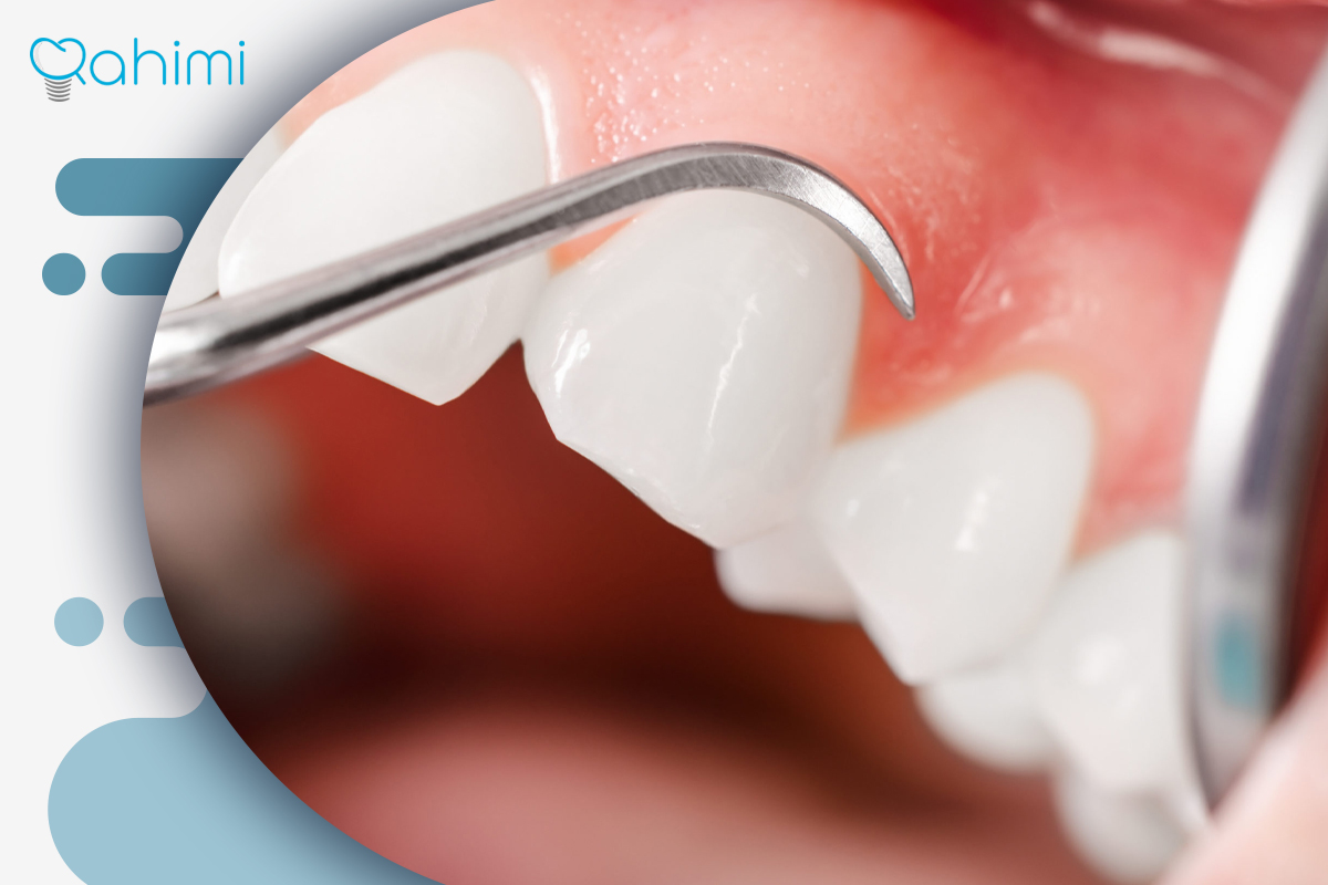 لیفت لثه چیست؟ فواید لیفت لثه با جراحی و لیزر 5 لیفت لثه لیزری