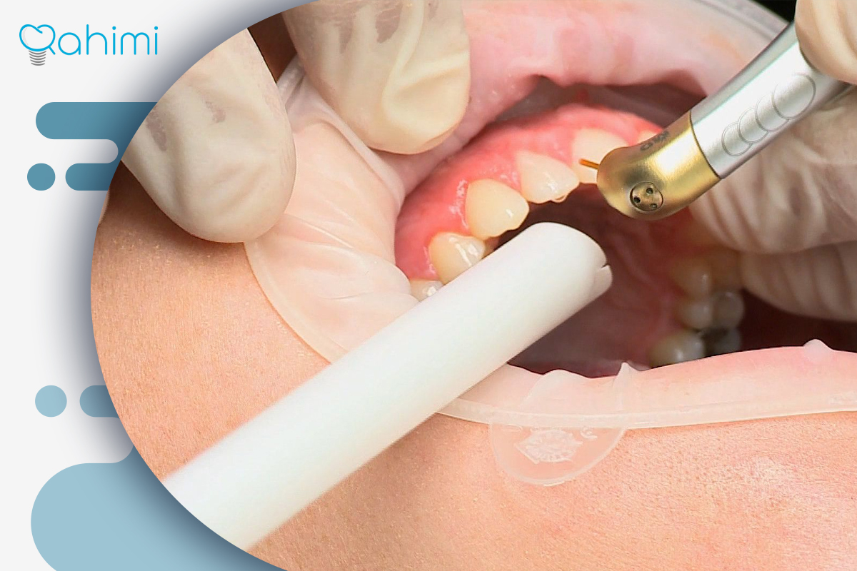 لیفت لثه چیست؟ فواید لیفت لثه با جراحی و لیزر 2 انجام لیفت لثه