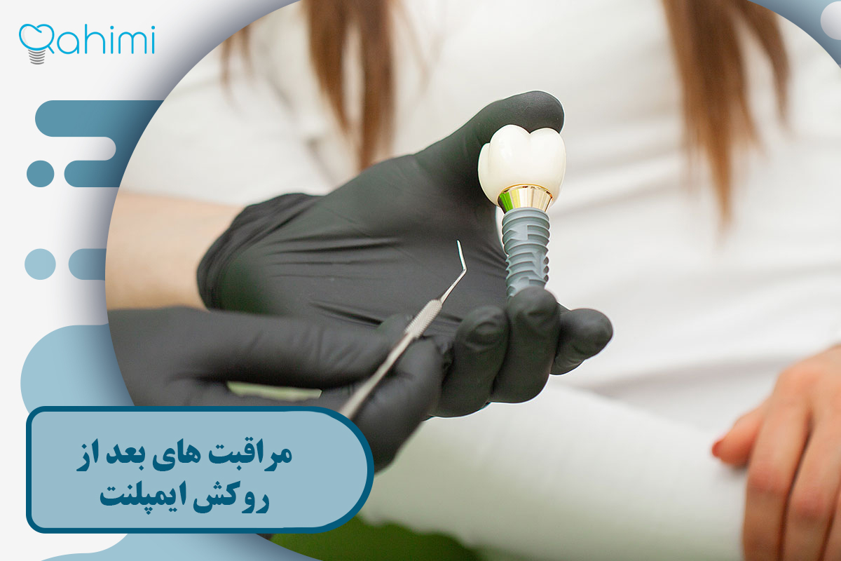 مراقبت های بعد از روکش ایمپلنت