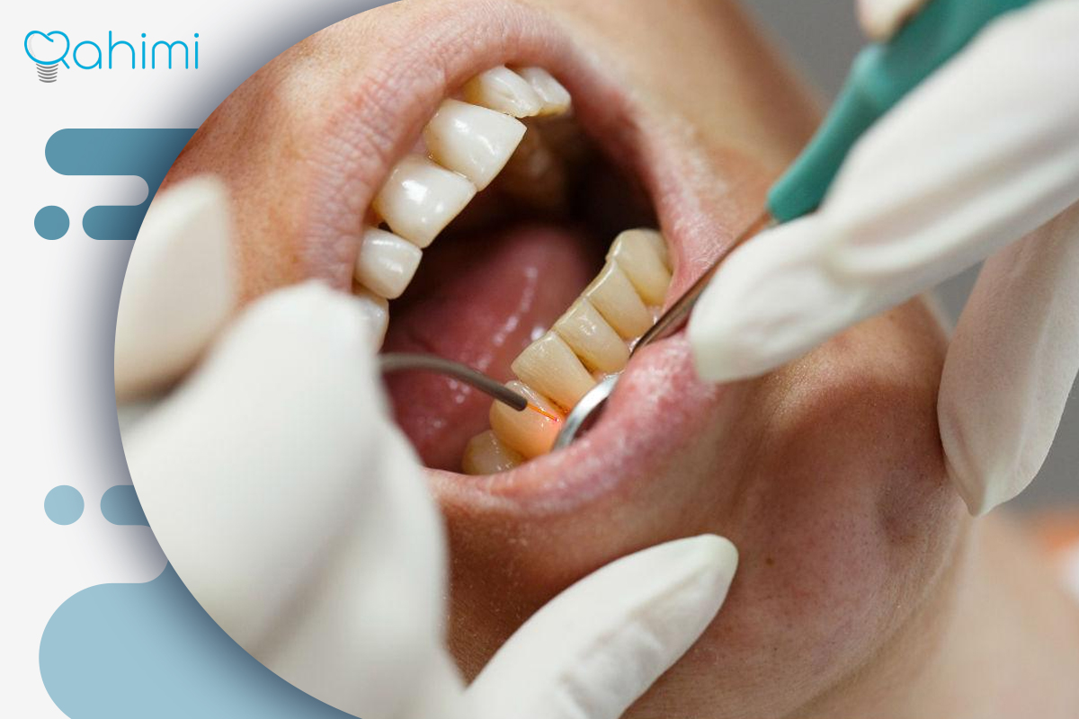 لیفت لثه چیست؟ فواید لیفت لثه با جراحی و لیزر 3 مراحل انجام لیفت لثه