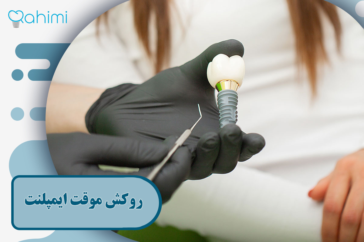 روکش موقت ایمپلنت