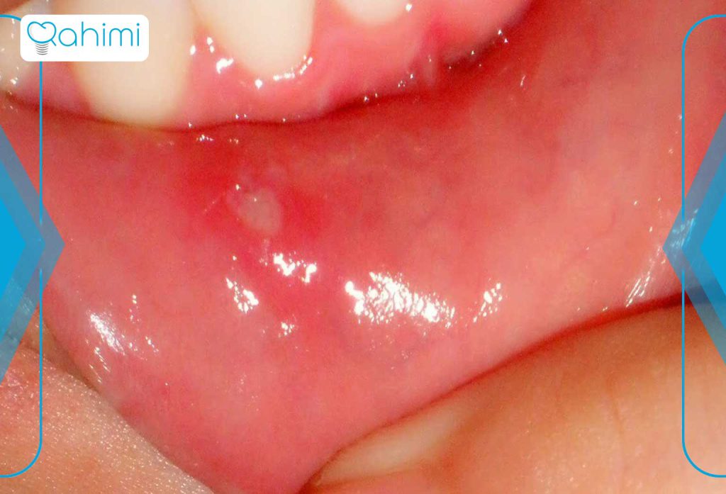 تبخال لثه چیست و چگونه درمان میشود؟ 4 تشخیص تبخال لثه
