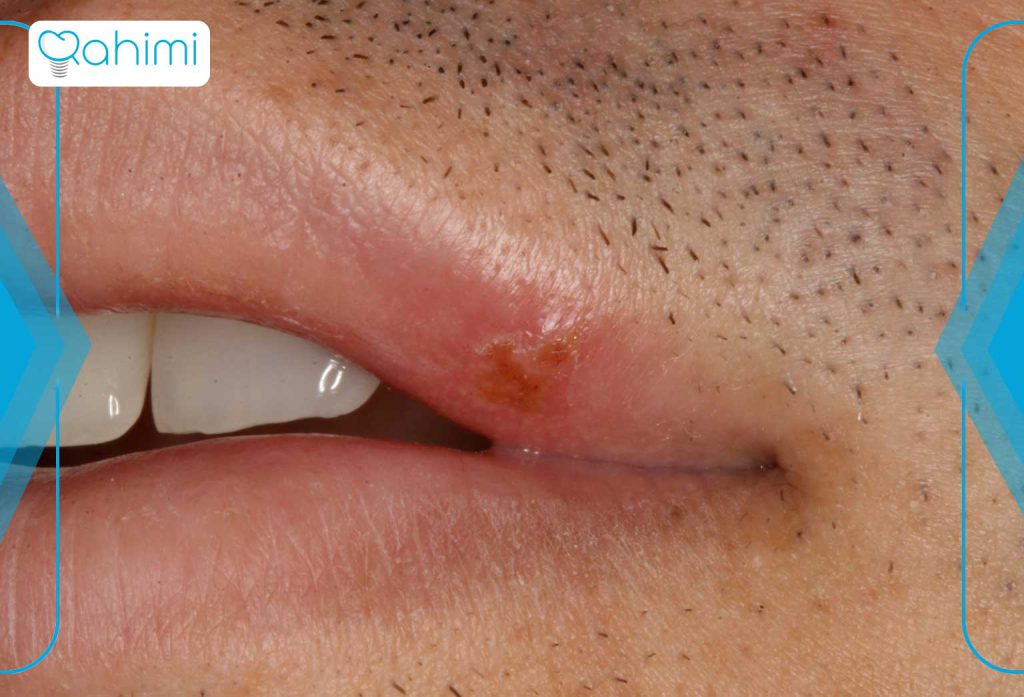تبخال لثه چیست و چگونه درمان میشود؟ 1 علائم تبخال لثه