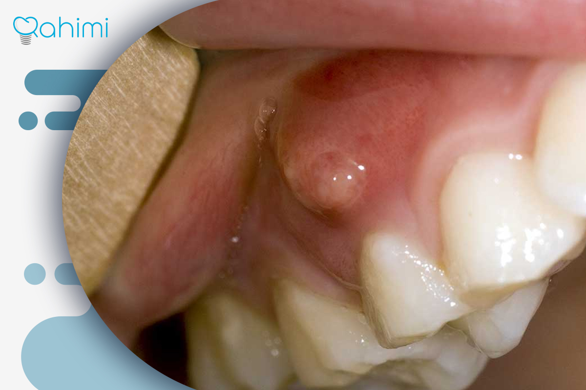 جوش سفید روی لثه | علت، درمان و زمان مراجعه به دندانپزشک 1 علل ایجاد جوش سفید روی لثه
