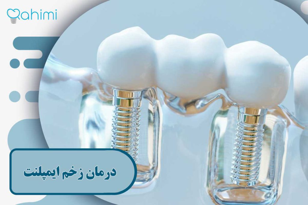 درمان زخم ایمپلنت دندان