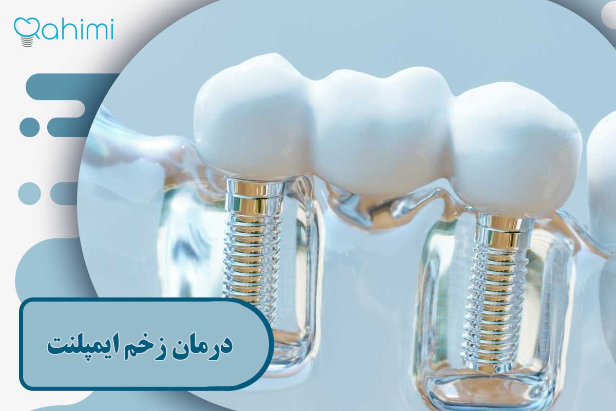 درمان زخم ایمپلنت دندان