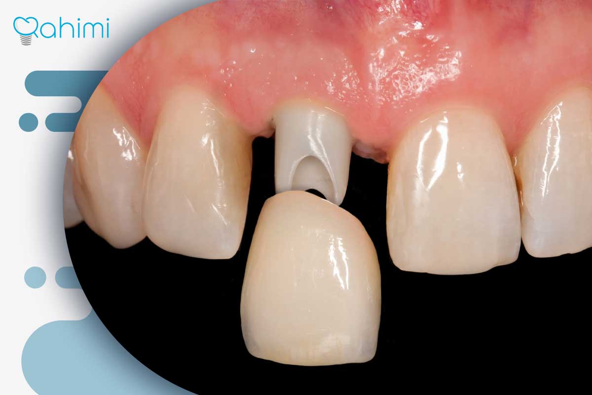 لب پر شدن روکش ایمپلنت دندان؛ علت، ترمیم و تعویض تخصصی در قم با دکتر حامد رحیمی 2 تغییر رنگ روکش ایمپلنت دندان