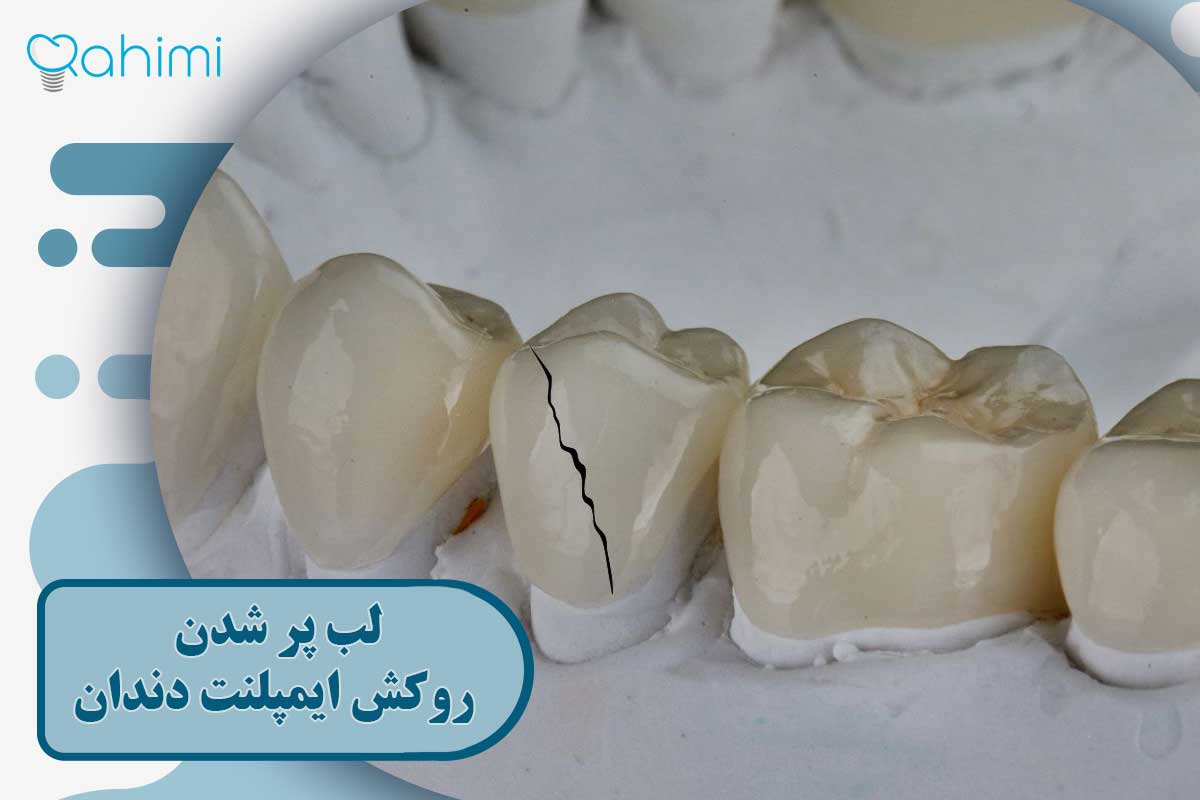 لب پر شدن روکش ایمپلنت دندان