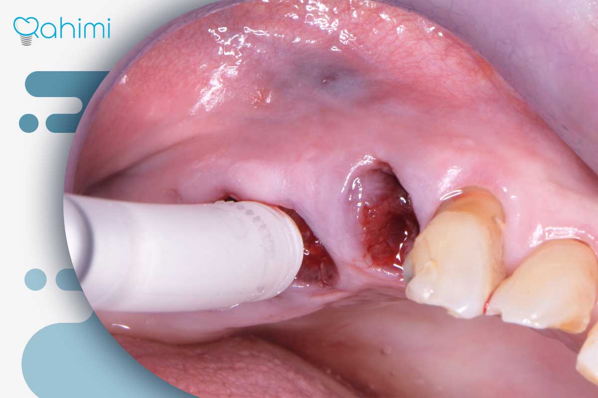مدت‌زمان ترمیم زخم ایمپلنت دندان