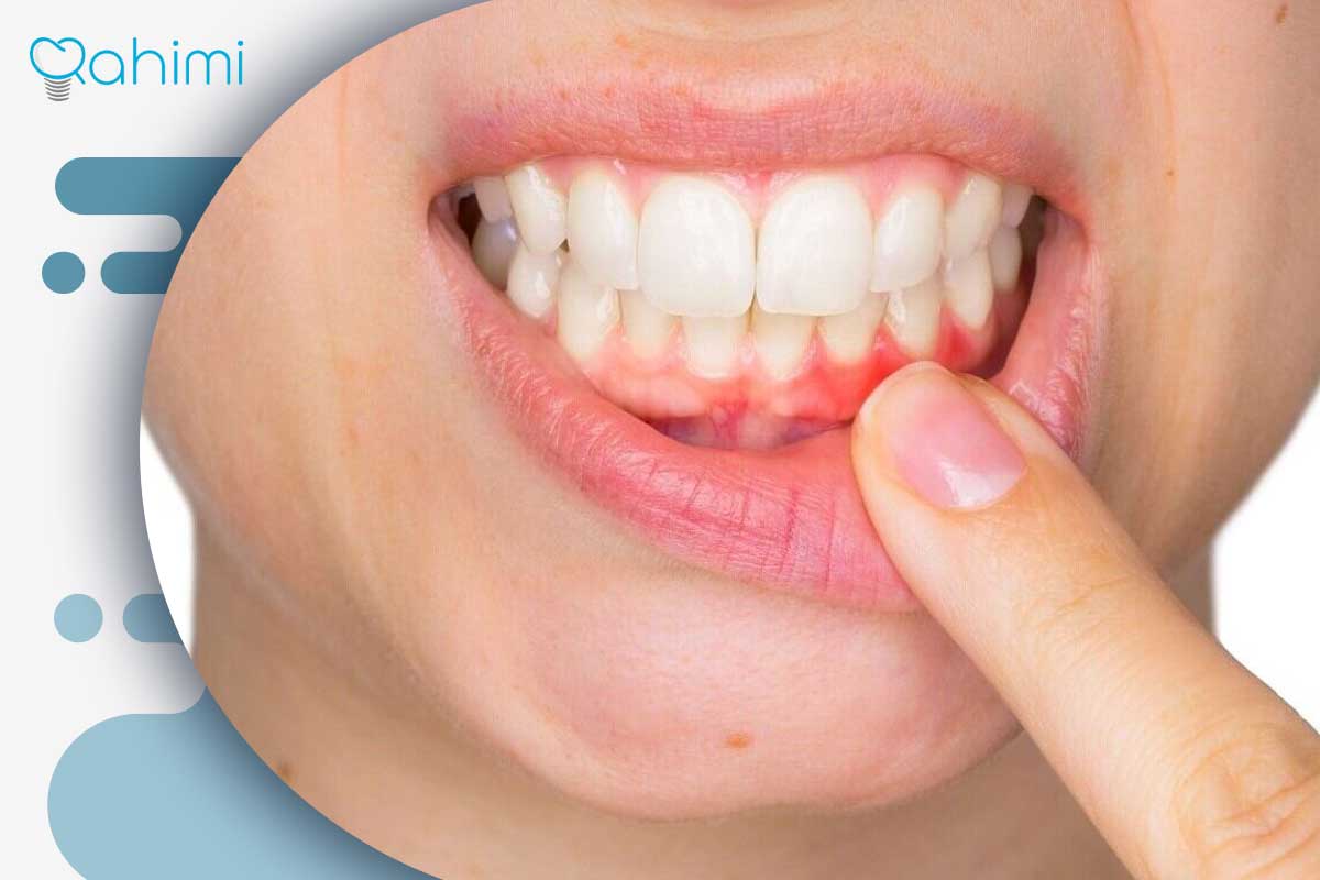 درمان خانگی هوا کشیدن دندان | راهکارهای مؤثر برای تسکین سریع درد 4 عوامل زمینهای هوا کشیدن دندان