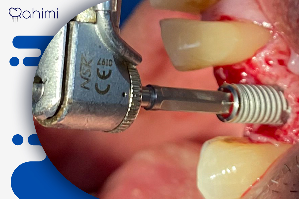 مراحل درمان ایمپلنت به روش پانچ در کلینیک دکتر حامد رحیمی