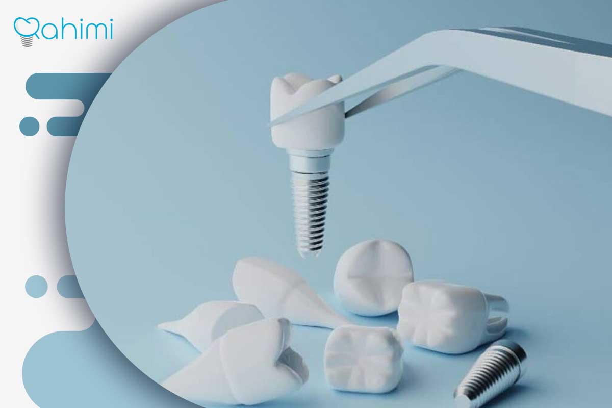 ایمپلنت فوری یا یک‌روزه