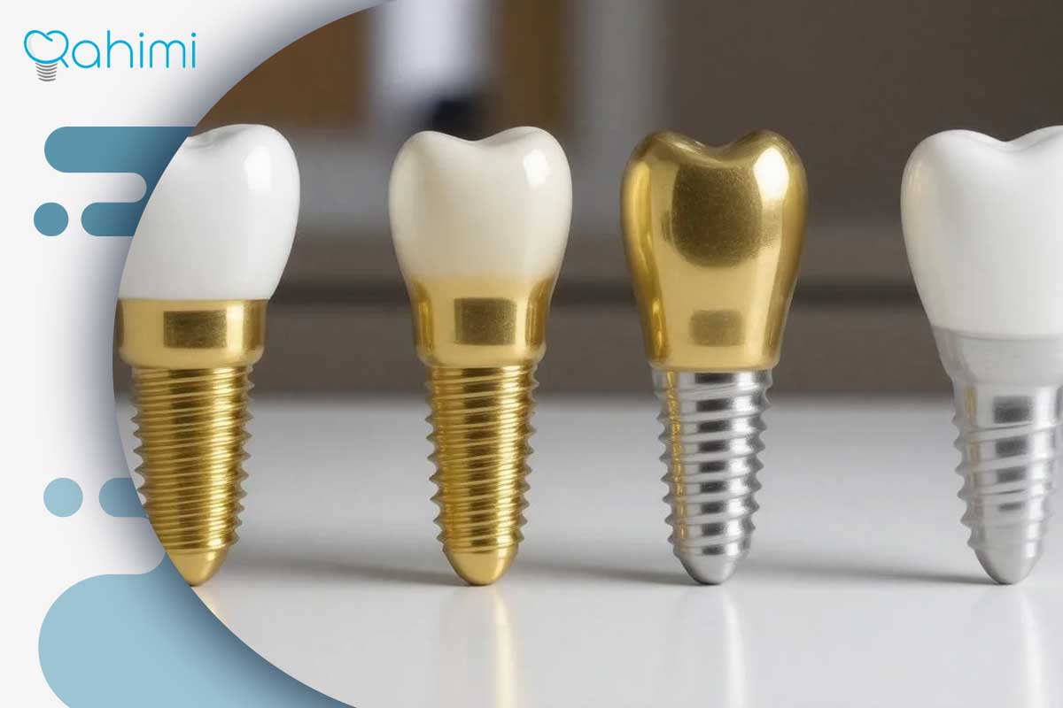 لب پر شدن روکش ایمپلنت دندان؛ علت، ترمیم و تعویض تخصصی در قم با دکتر حامد رحیمی 5 مدت زمان تعویض روکش ایمپلنت