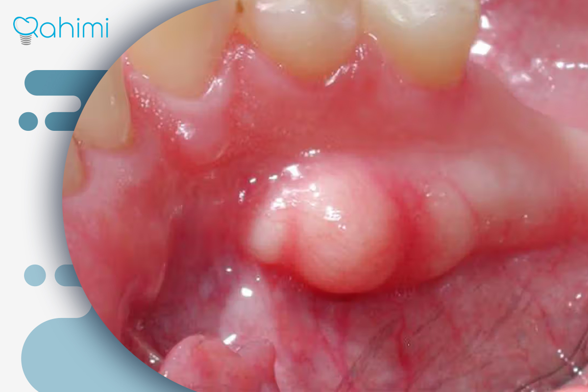 جوش سفید روی لثه | علت، درمان و زمان مراجعه به دندانپزشک 2 علل پزشکی یا سیستمیک جوش سفید روی لثه