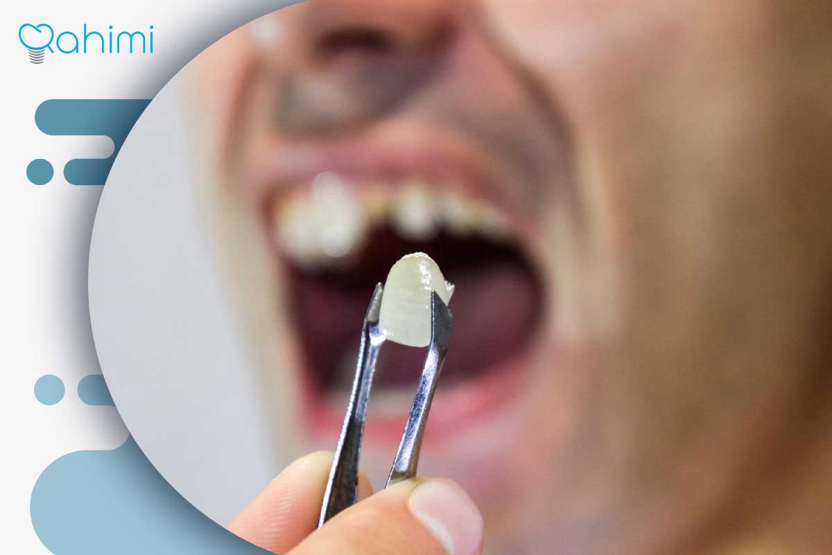 لب پر شدن روکش ایمپلنت دندان؛ علت، ترمیم و تعویض تخصصی در قم با دکتر حامد رحیمی 4 درآوردن روکش ایمپلنت