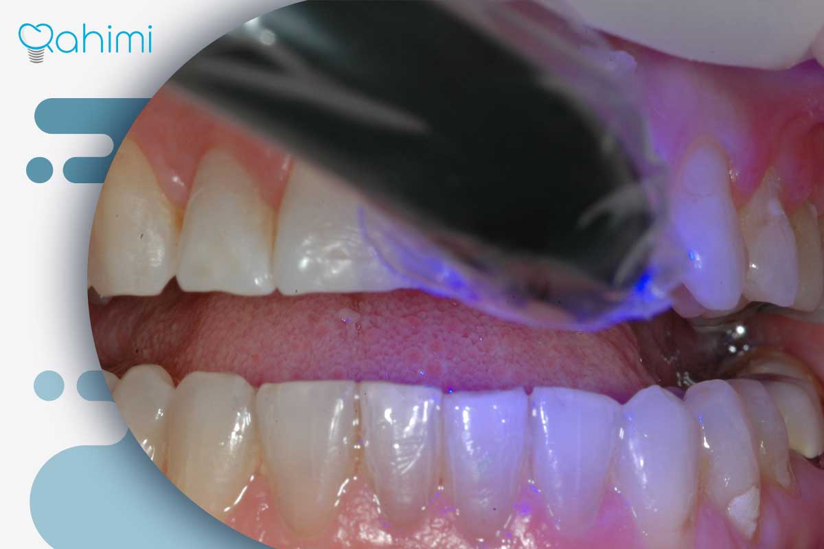 لب پر شدن روکش ایمپلنت دندان؛ علت، ترمیم و تعویض تخصصی در قم با دکتر حامد رحیمی 3 ترمیم روکش دندان