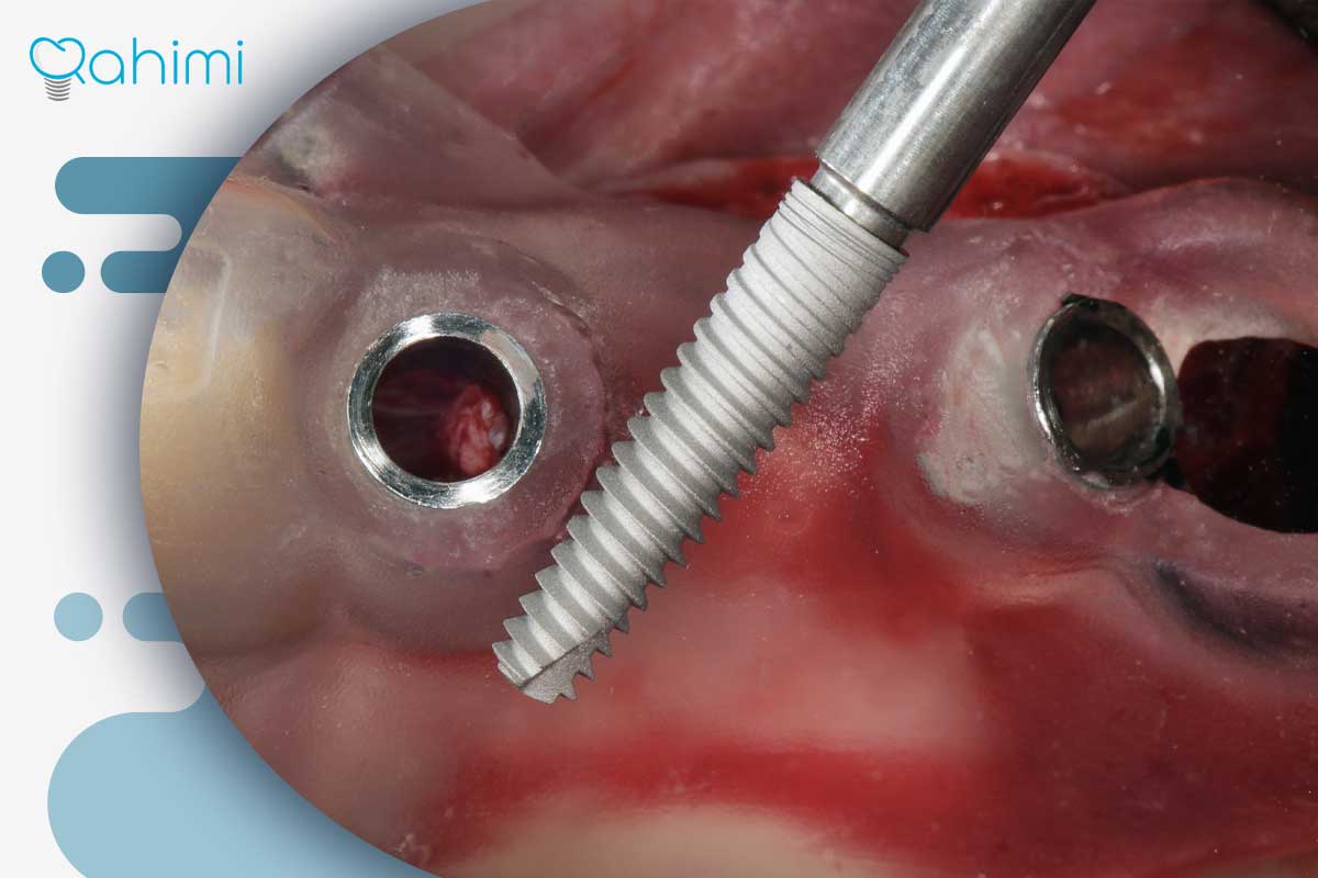 درمان تخصصی زخم ایمپلنت دندان