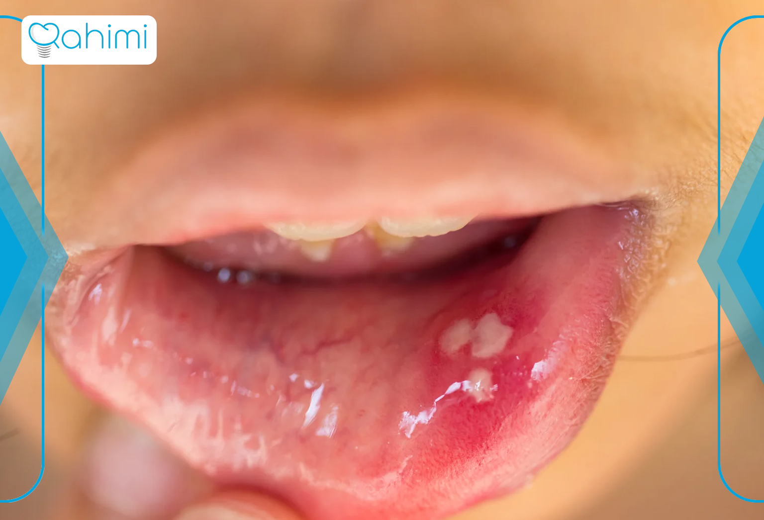 تفاوت آفت و تبخال دهان