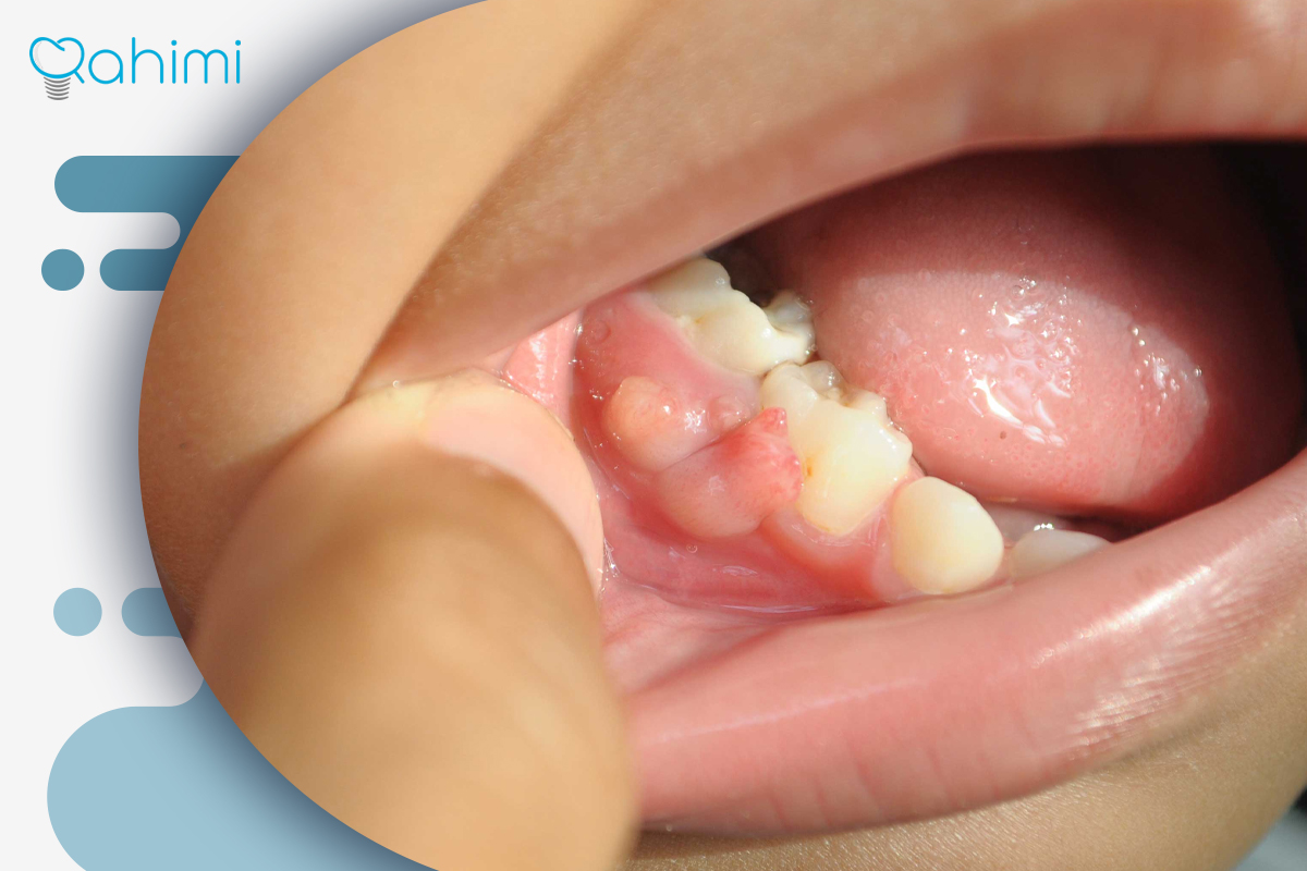 جوش سفید روی لثه | علت، درمان و زمان مراجعه به دندانپزشک 3 انواع جوش سفید روی لثه