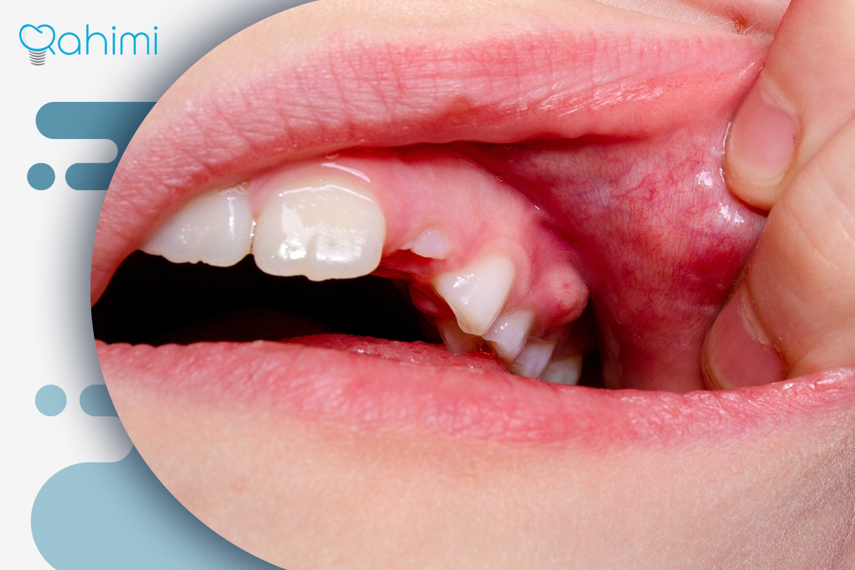 جوش سفید روی لثه | علت، درمان و زمان مراجعه به دندانپزشک 4 نشانههای هشداردهنده جوش سفید روی لثه