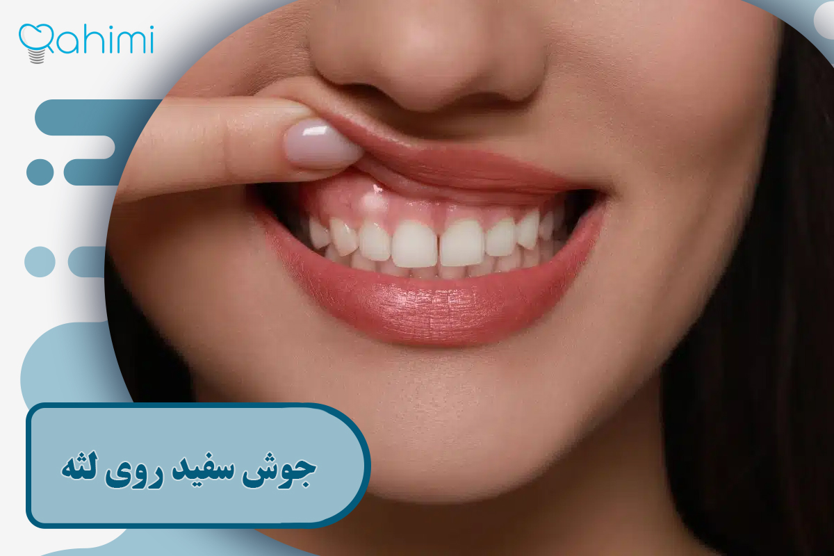 جوش سفید روی لثه