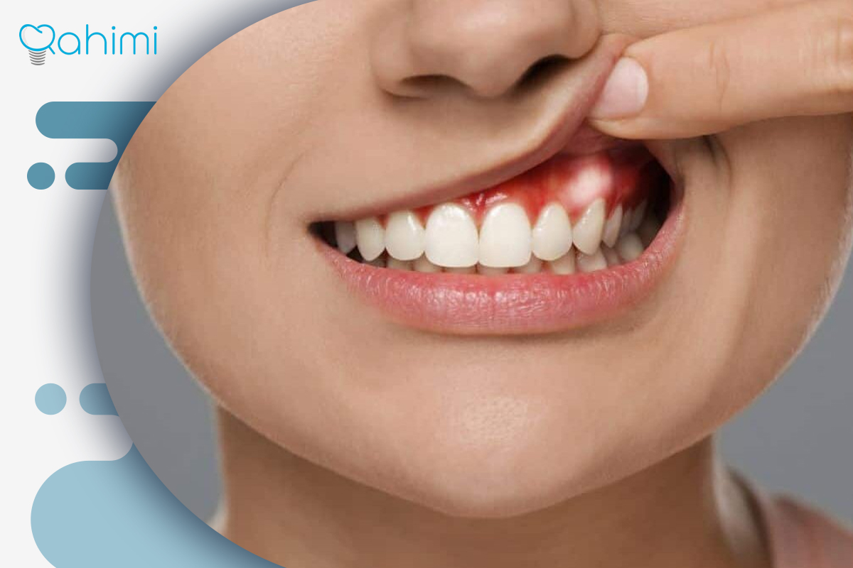 جوش سفید روی لثه | علت، درمان و زمان مراجعه به دندانپزشک 9 جوش لثه