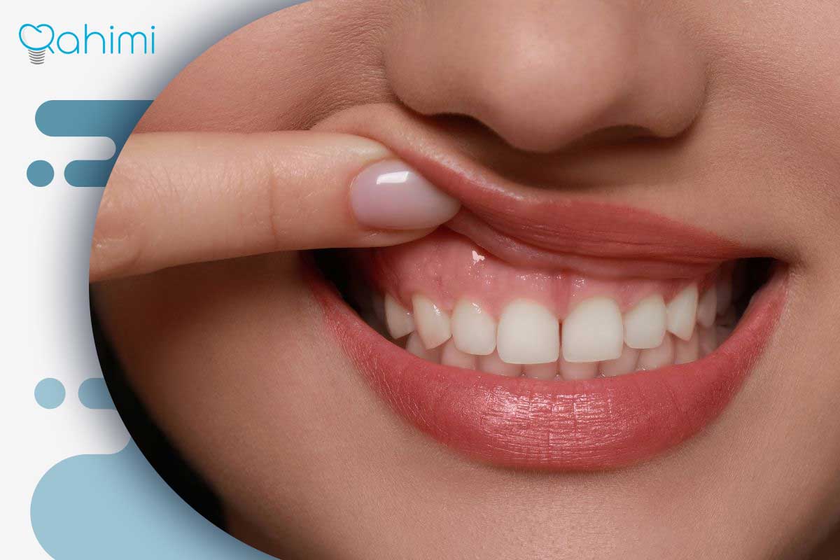 ترمیم لثه و درمان تحلیل لثه؛ علائم، علتها و روشهای جراحی و غیرجراحی 11 مزایای ترمیم لثه و تأثیر آن بر لبخند و سلامت دهان