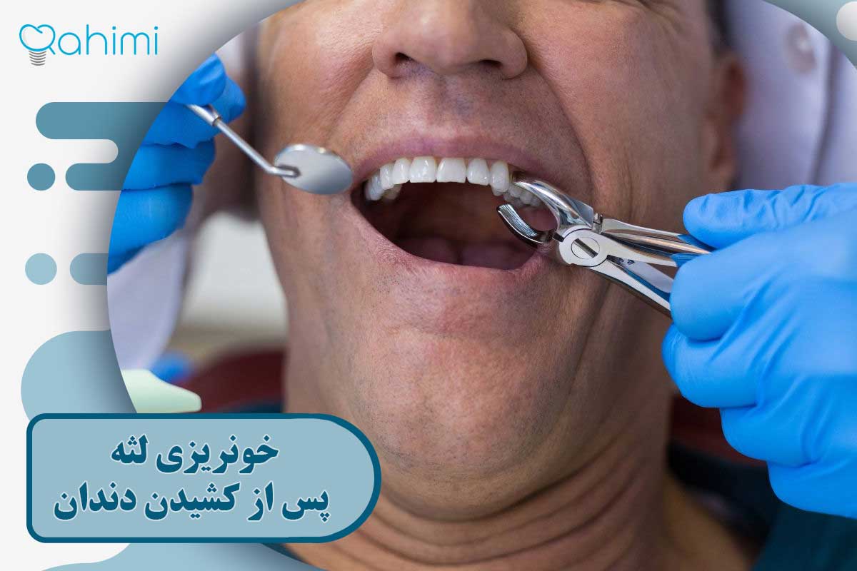 خونریزی لثه پس از کشیدن دندان