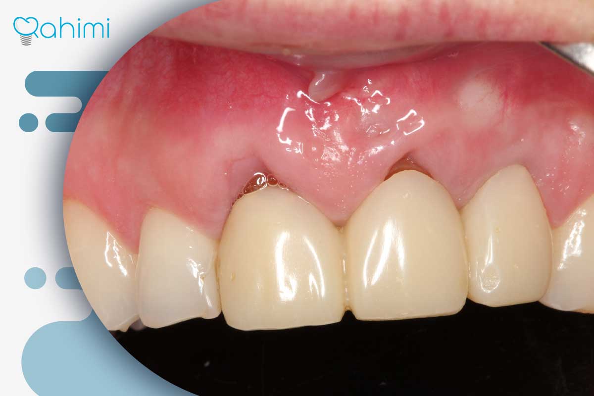 حساسیت به ایمپلنت دندان؛ علائم، علتها و روشهای کنترل واکنشهای ایمپلنت 4 علتهای حساسیت به ایمپلنت دندان