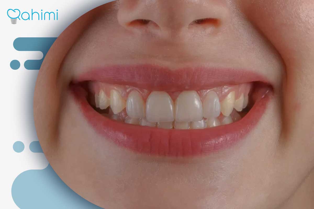 سوراخ شدن لثه؛ دلایل ایجاد حفره در لثه و بهترین روشهای درمان و پیشگیری 2 تغییر شکل لثه اطراف دندان