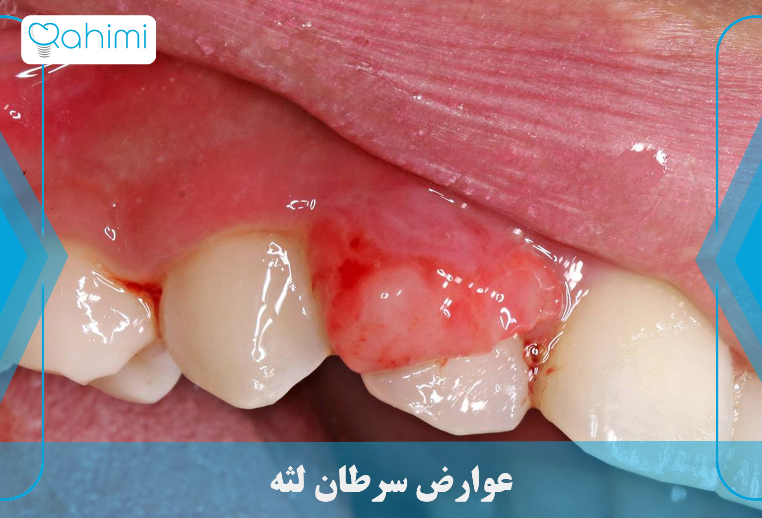 Complications of gum cancer 1