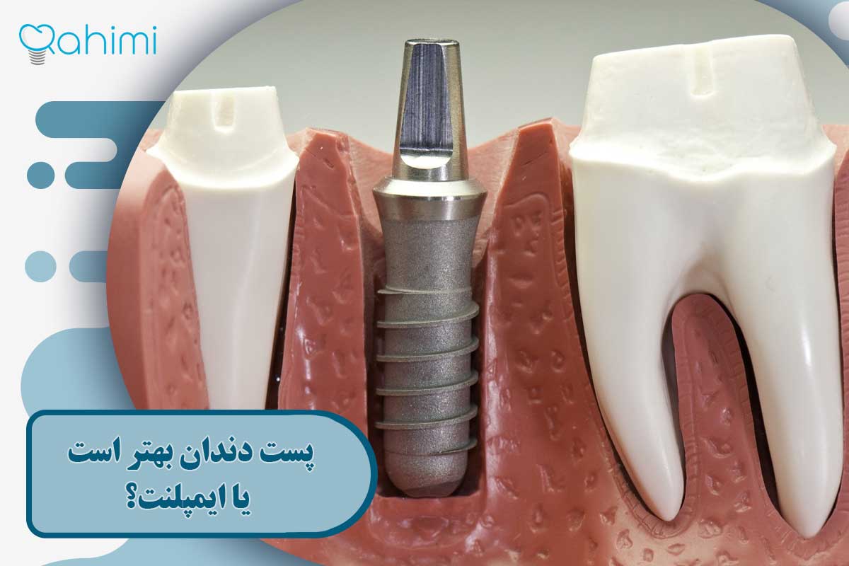 پست و ایمپلنت دندان: پست دندان بهتر است یا ایمپلنت؟ 6 پست و ایمپلنت دندان