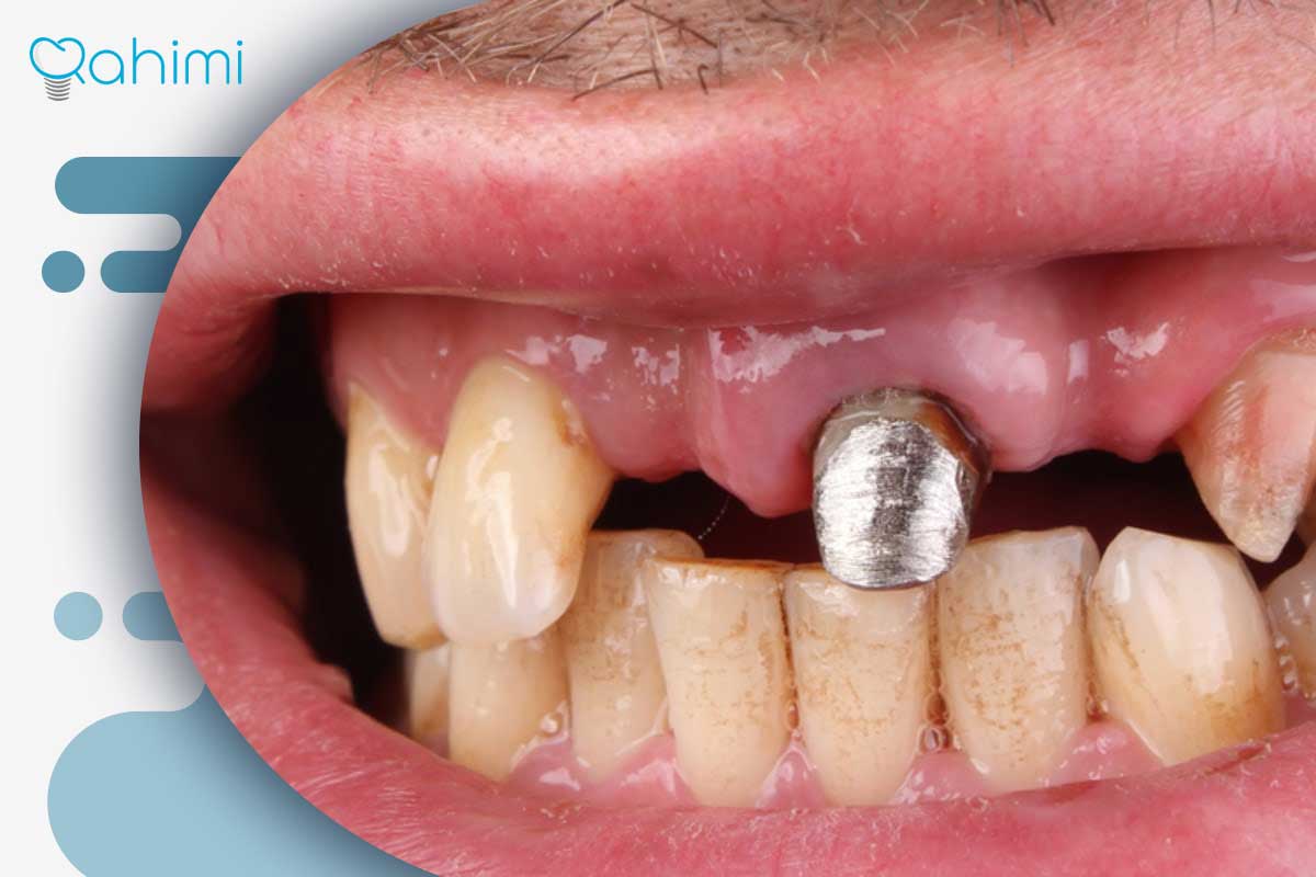 پست و ایمپلنت دندان: پست دندان بهتر است یا ایمپلنت؟ 3 ایمپلنت دندان