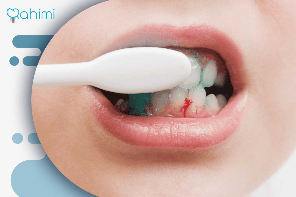 مراقبت‌های ضروری پس از کشیدن دندان برای جلوگیری از خونریزی