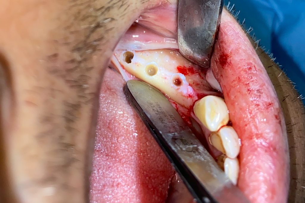 اهمیت انتخاب متخصص ایمپلنت دندان در قم برای درمان موفق (دکتر رحیمی) 9 Fig 1a IMG 6770 1024x683 1