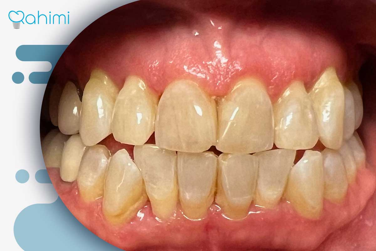 ترمیم لثه و درمان تحلیل لثه؛ علائم، علتها و روشهای جراحی و غیرجراحی 2 تحلیل لثه