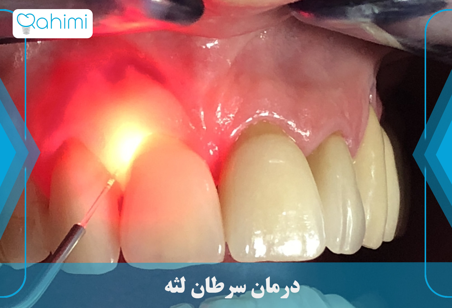 Gum cancer treatment
