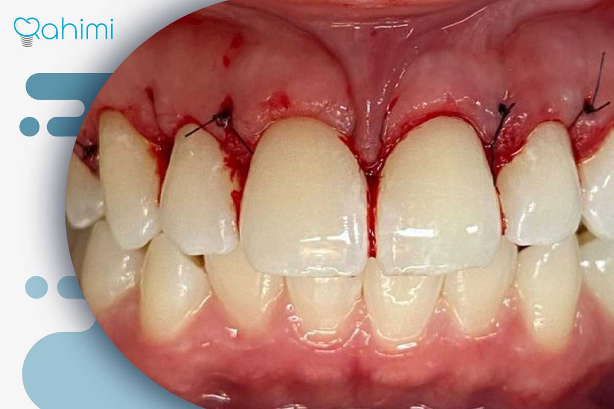 سوراخ شدن لثه؛ دلایل ایجاد حفره در لثه و بهترین روشهای درمان و پیشگیری 5 درمان سوراخ لثه