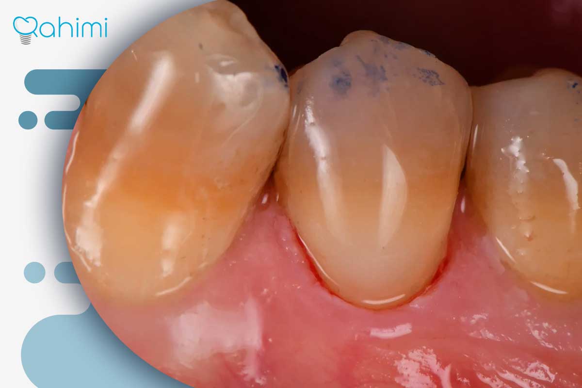 سوراخ شدن لثه؛ دلایل ایجاد حفره در لثه و بهترین روشهای درمان و پیشگیری 4 حفره خط لثه