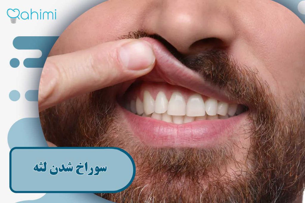 سوراخ شدن لثه