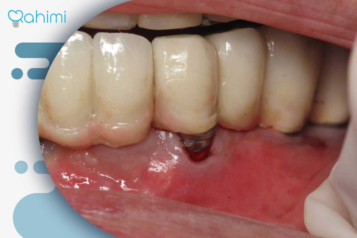 ترمیم لثه و درمان تحلیل لثه؛ علائم، علتها و روشهای جراحی و غیرجراحی 5 تحلیل لثه بعد از ایمپلنت