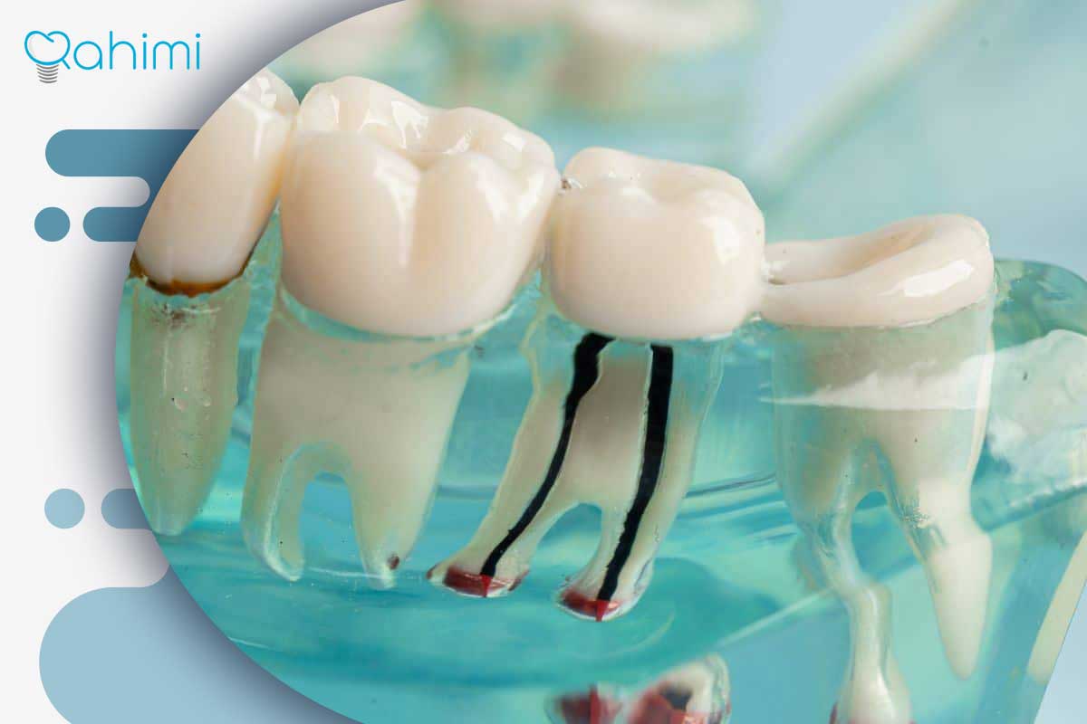پست و ایمپلنت دندان: پست دندان بهتر است یا ایمپلنت؟ 10 ریشه دندان سالم
