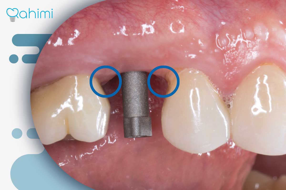 بوی بد دهان بعد از ایمپلنت: چرا دندان ایمپلنت بو میدهد؟ 3 طراحی نامناسب روکش ایمپلنت