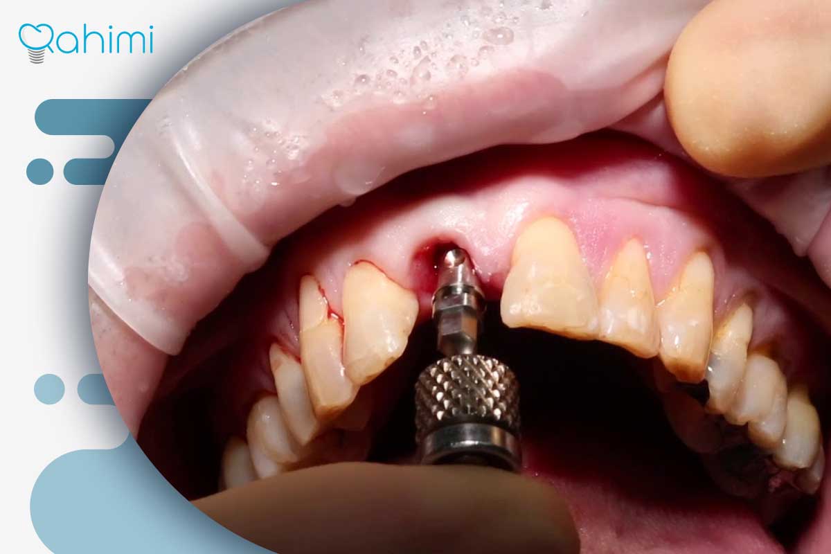 پست و ایمپلنت دندان: پست دندان بهتر است یا ایمپلنت؟ 7 نصب ایمپلنت برای دندانشکسته