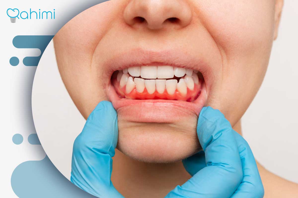 ترمیم لثه و درمان تحلیل لثه؛ علائم، علتها و روشهای جراحی و غیرجراحی 3 افرادی بیشتر مستعد تحلیل لثه هستن