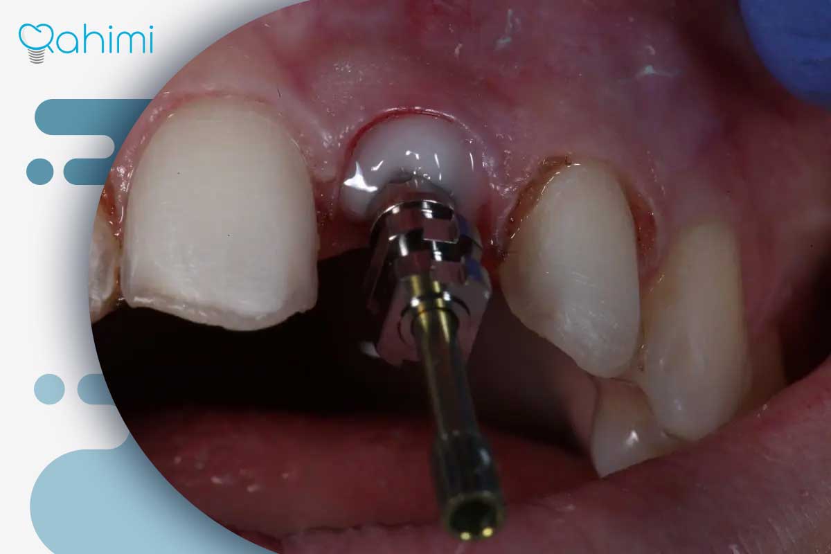 پست و ایمپلنت دندان: پست دندان بهتر است یا ایمپلنت؟ 8 نصب پست با شکستگی استخوان دندان