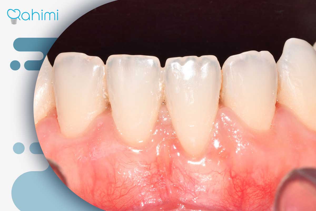 ترمیم لثه و درمان تحلیل لثه؛ علائم، علتها و روشهای جراحی و غیرجراحی 13 جلوگیری از بازگشت تحلیل لثه